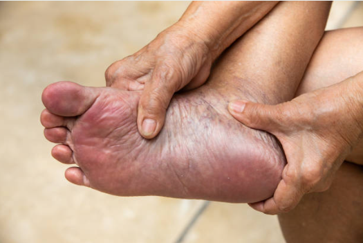 Progression of nerve damage